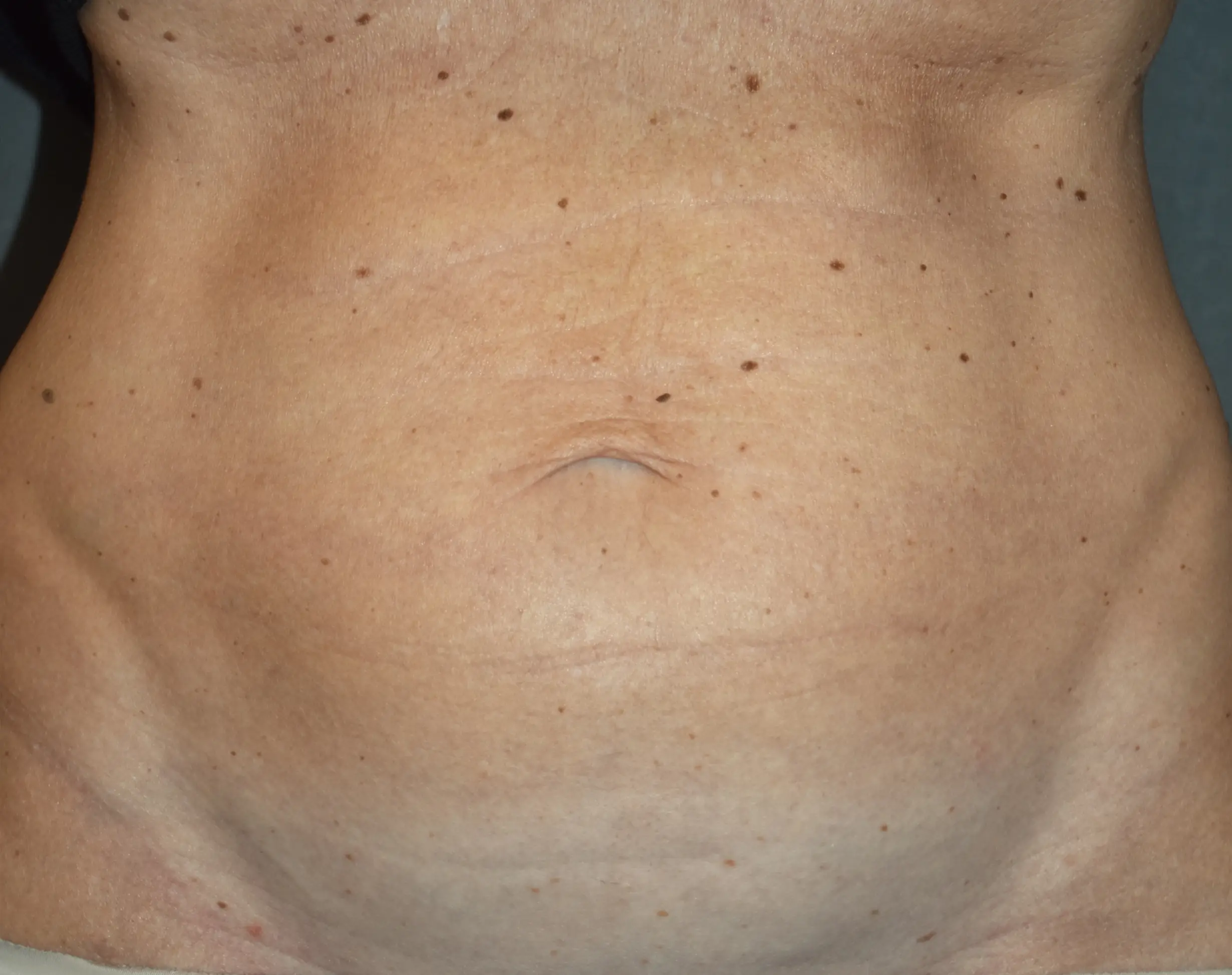 Morpheus8 BODY 3D - addome dopo