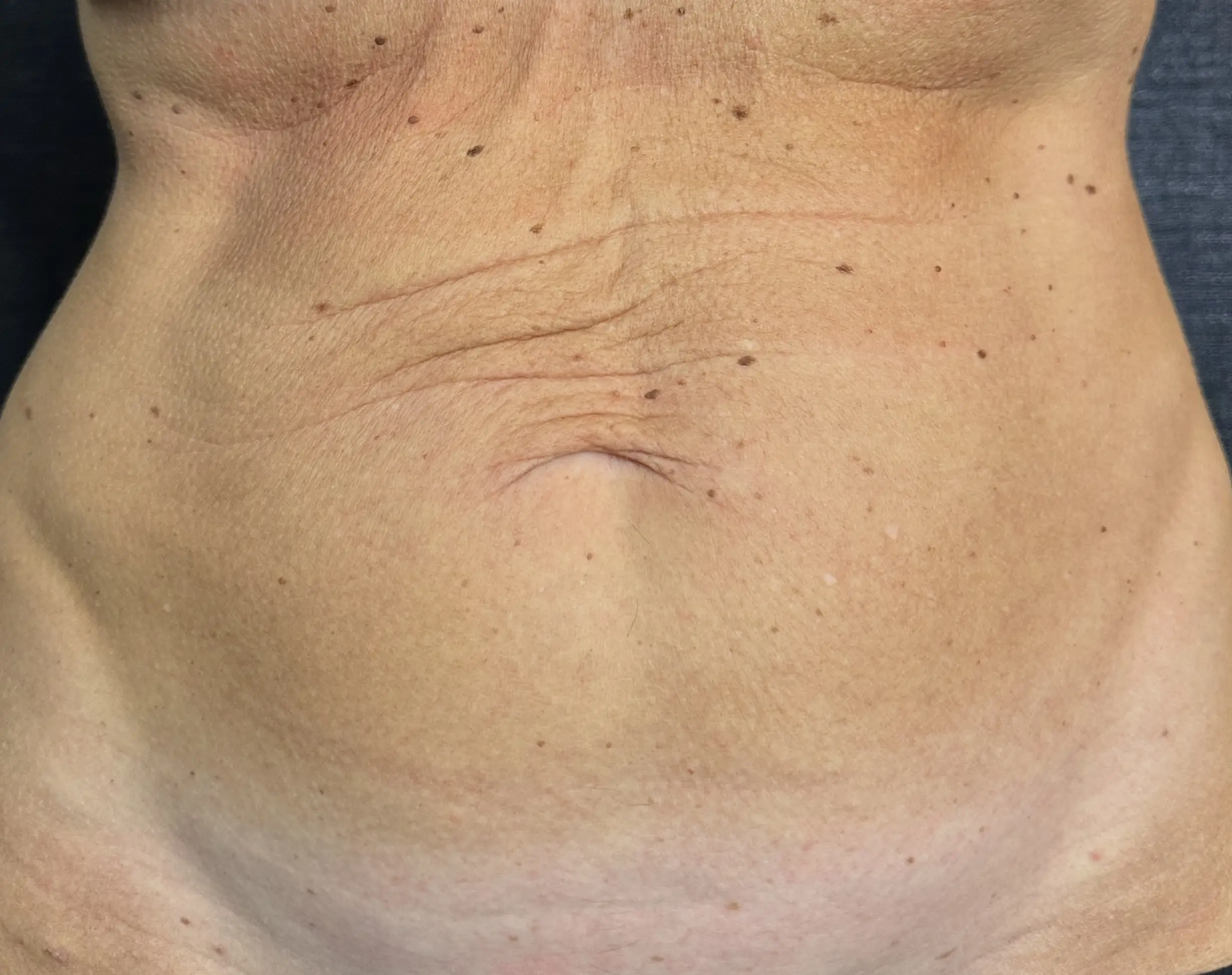 Morpheus8 BODY 3D - addome prima