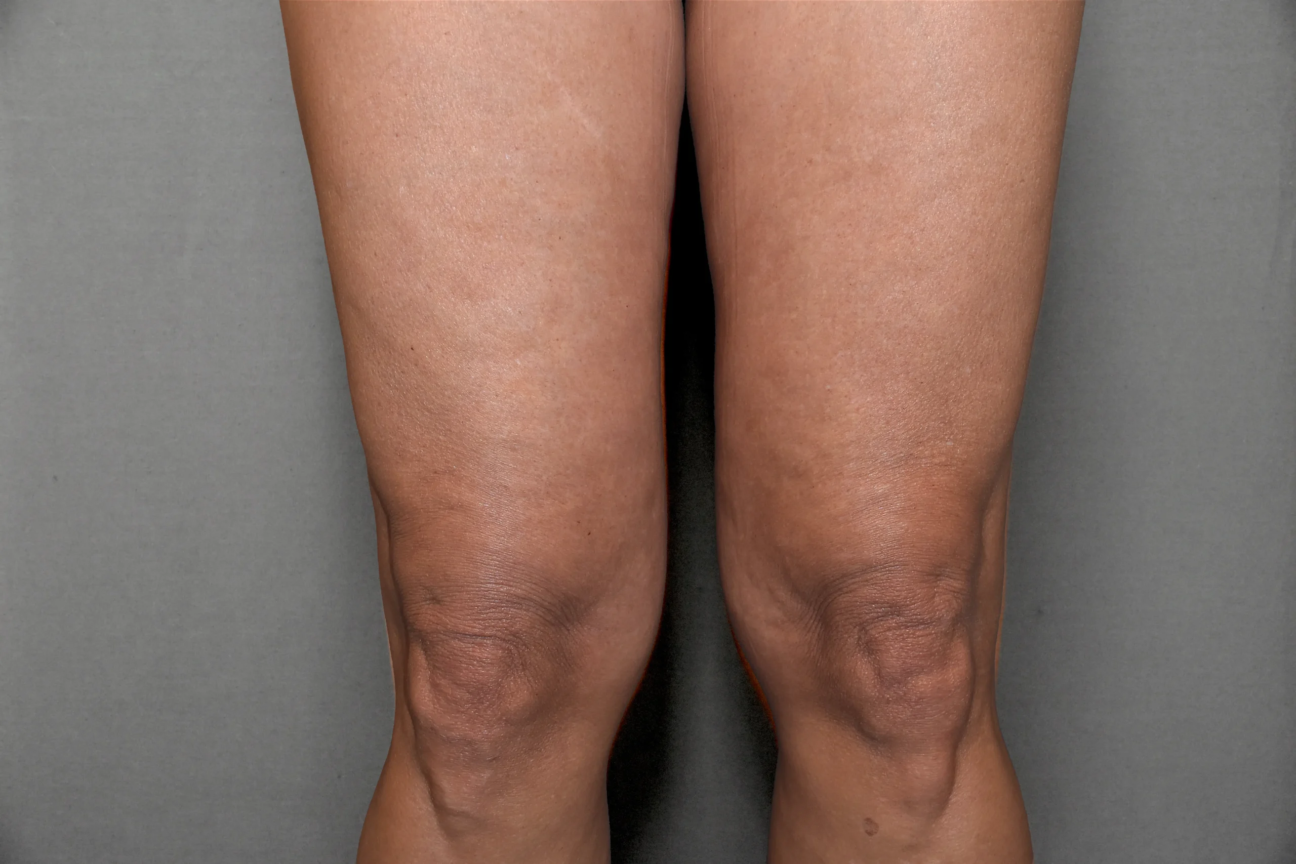 Morpheus8 BODY 3D - ginocchia dopo