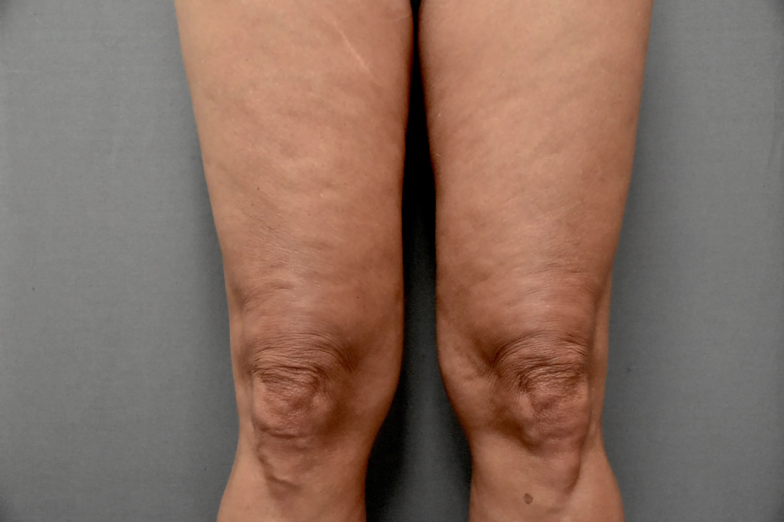 Morpheus8 BODY 3D - ginocchia prima