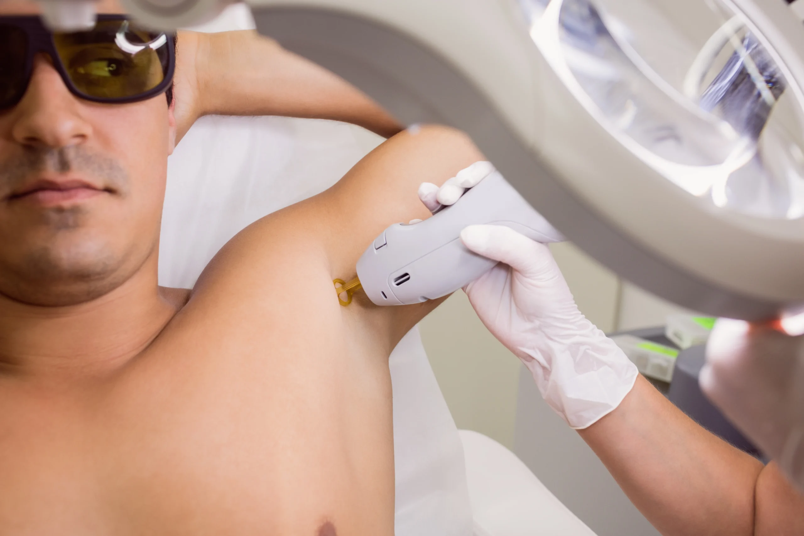 Epilazione laser inguine e ascelle anche in estate