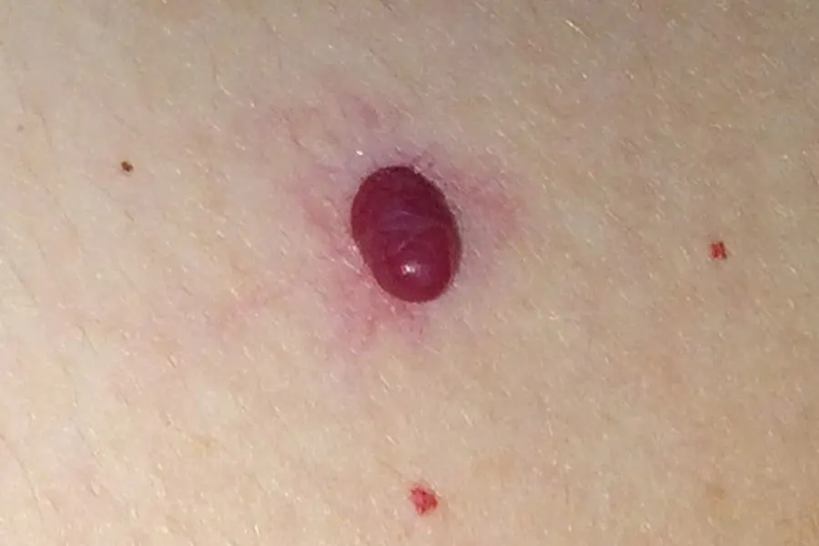 dermatologia angiomi